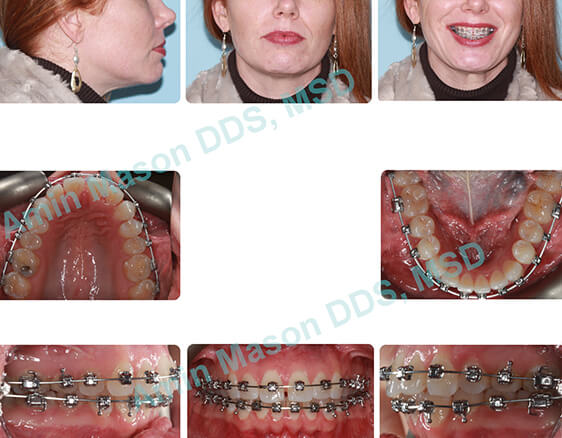 Woman's smile during treatment with self-litigating braces