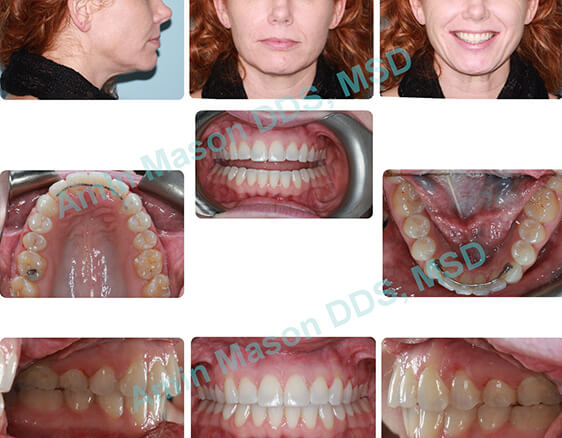 Woman's perfected smile following self-litigating braces