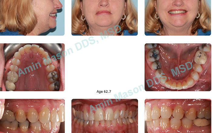 Older woman with perfectly aligned teeth after tretment
