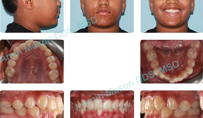 Woman's smile before orthodontic treatment