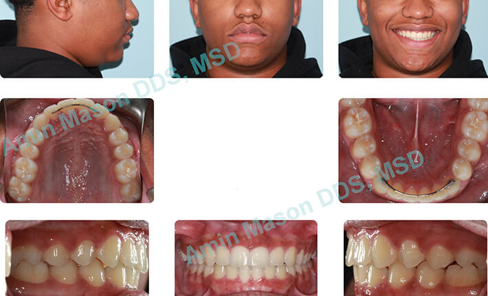 Woman's smile following orthodontic treatment