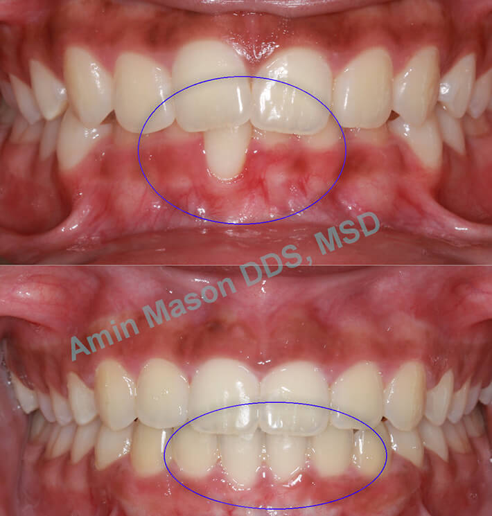 Before and after closeup of woman's smile