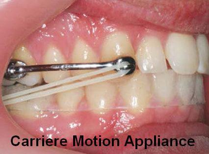 Image of smile with Carriere motion appliance
