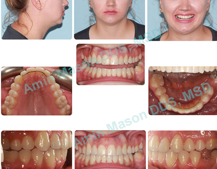 Woman's smile after Invisalign orthodontic treatment