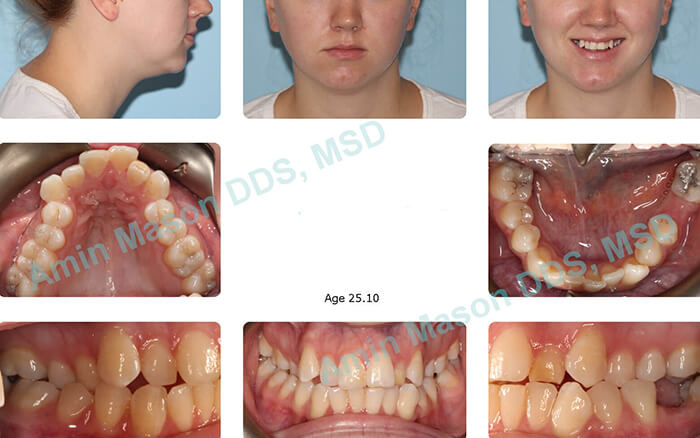 Before images of young woman with severe crossbite