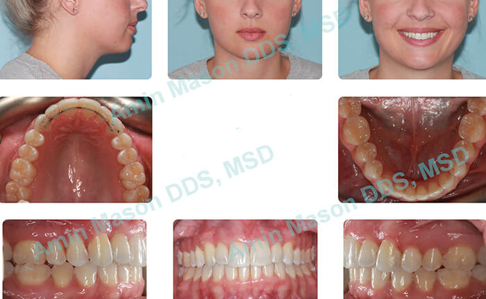 Woman following Invisalign and expander treatment