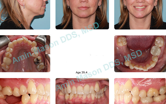 Woman's smile with missing teeth large gaps and uneven spacing