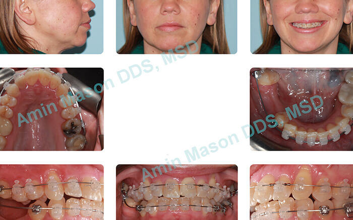 Woman's smile during clear braces treatment