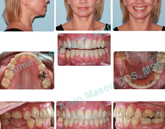 Woman's smile after orthodontic treatment and tooth replacement