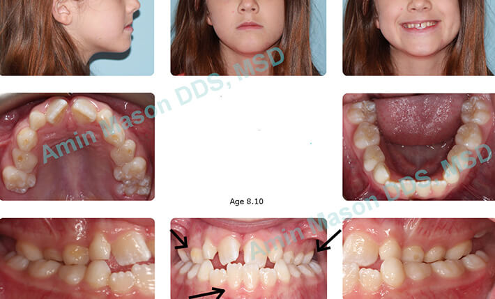 Preteen girl with crooked teeth