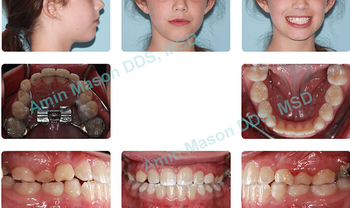 Preteen girl receiving early intervention orthodontics