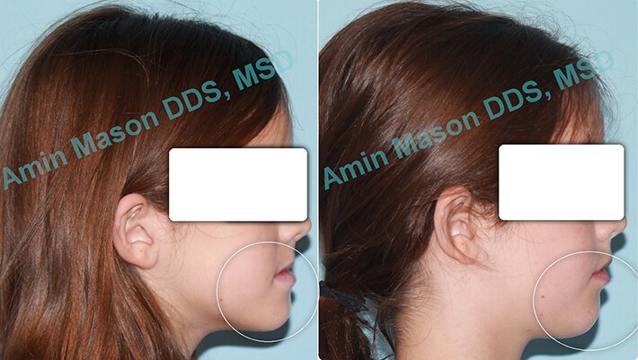 Change in facial shape following early intervention orthodontics