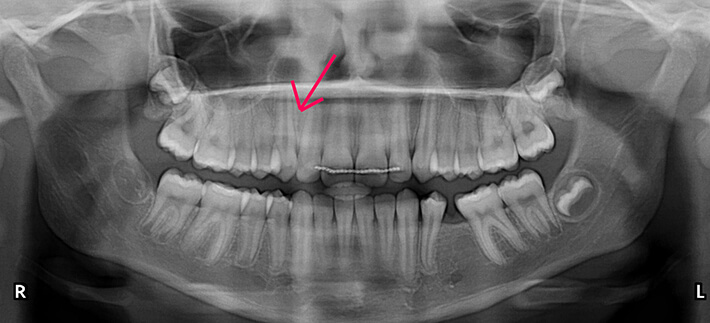 Panoramic dental x-ray showing smile following treatment