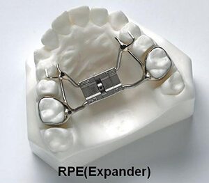 Models of teeth with palatal expanders