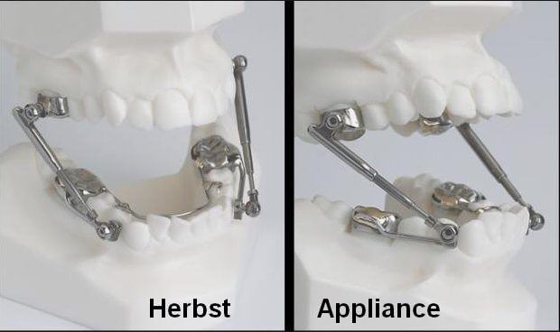 Teeth models with herbst appliance