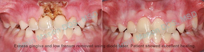 Smile after removal of excess gum tissue