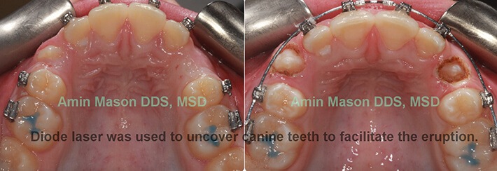 Before and after soft tissue laser uncovering teeth