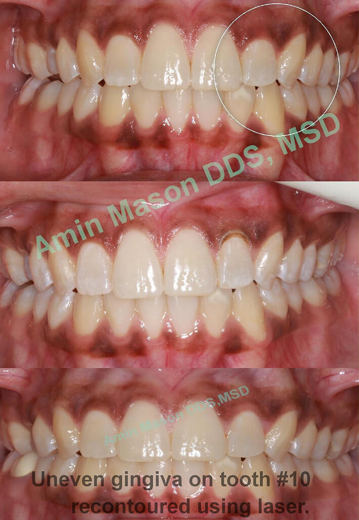 Smile before and after gingival recontouring