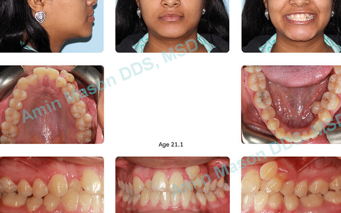 Woman before treatment with self-litigating braces