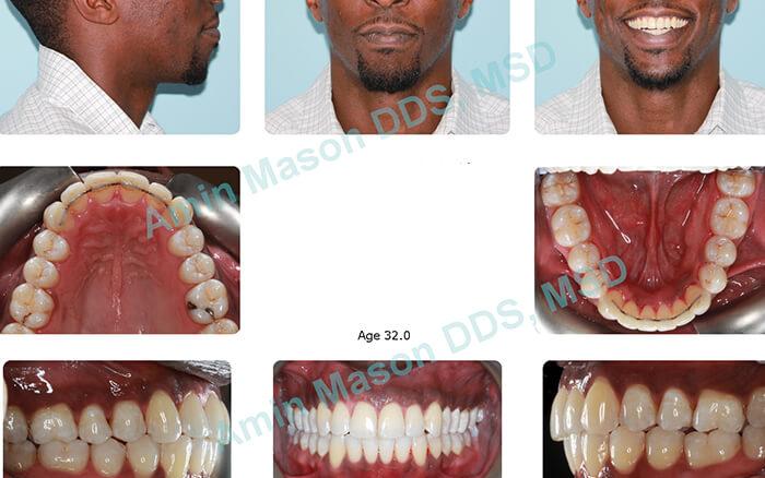 Man's smile after treatment with Incognito braces