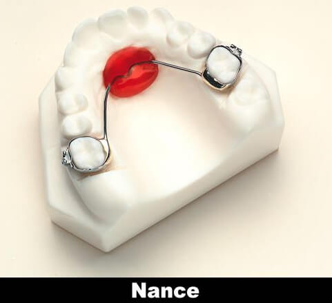 Model of teeth with Nance holding arch