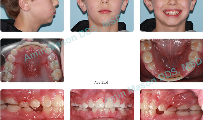 Young boy during treatment for open bite