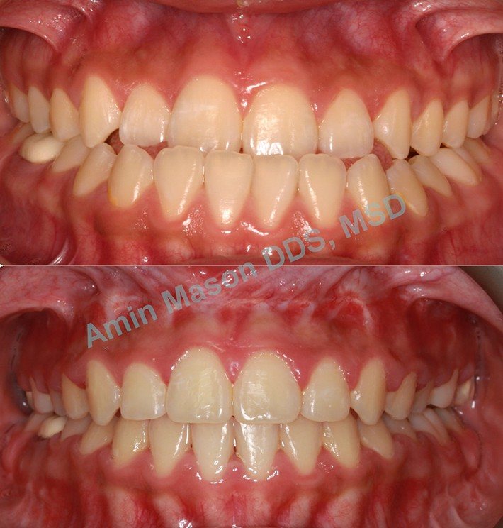 Before and after underbite closeup of teeth