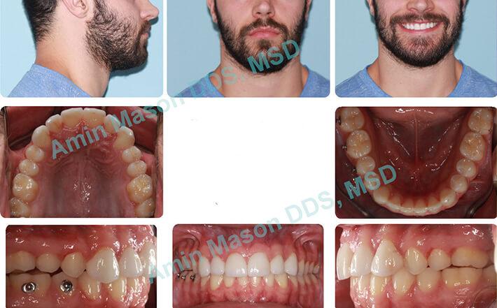 Man's teeth following TADs treatment to even out jaw line