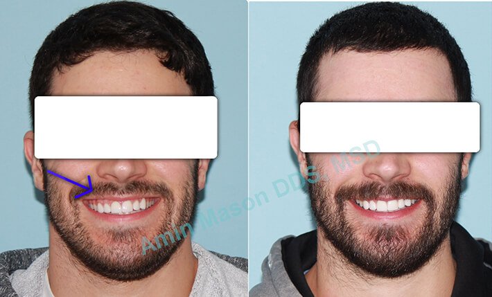 Before and after photos of man following TADs treatment