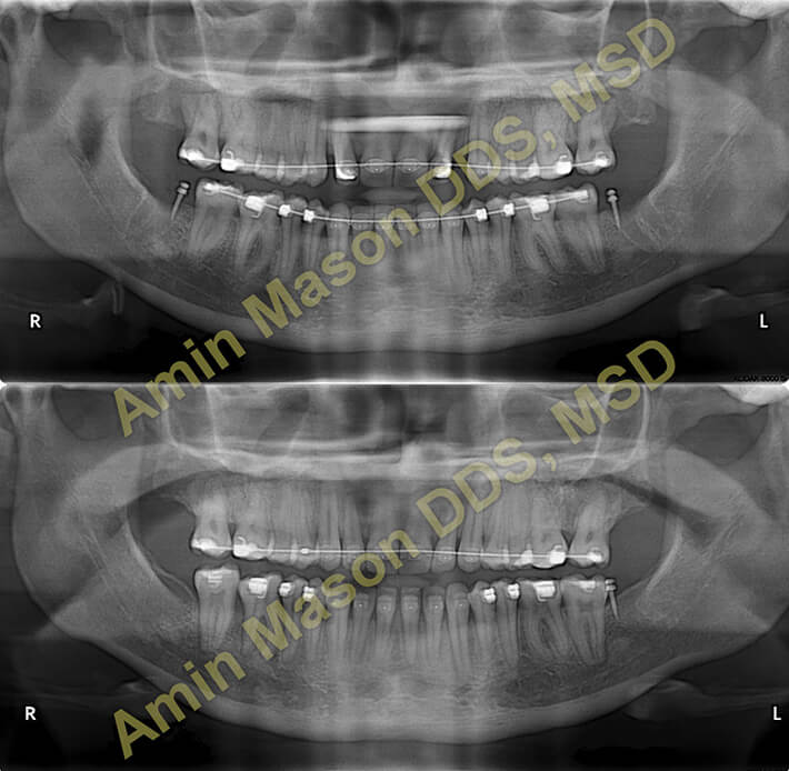 X-rays of patient before and after udnerbite