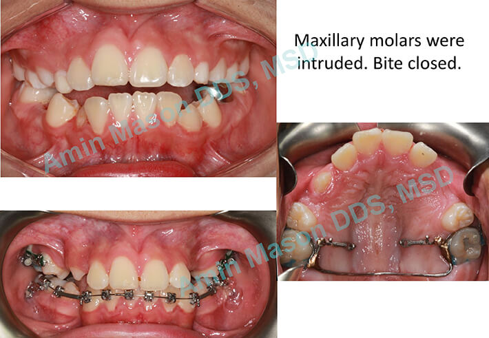 Collage of open bite treatment with TADs
