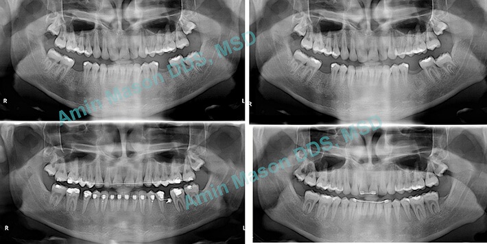 Collage of x-rays before and after TADS treatment to fill in missing teeth
