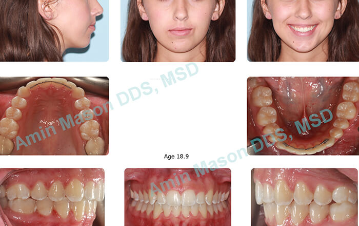 Collage of photos after treatment with Invisalign teen