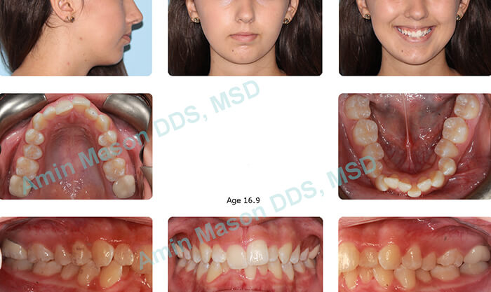 Collage of photos of girl with overbite and crowding