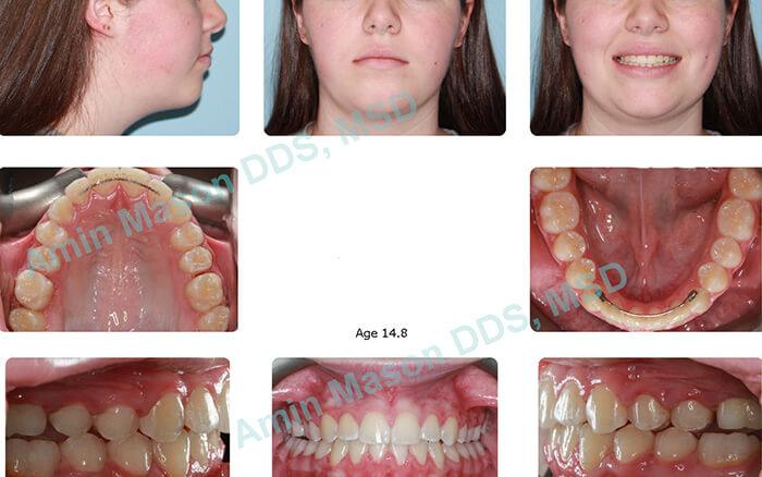 Young woman's smile after traditional braces