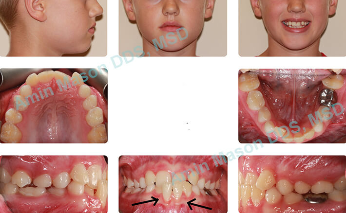 Young girl with severe underbite