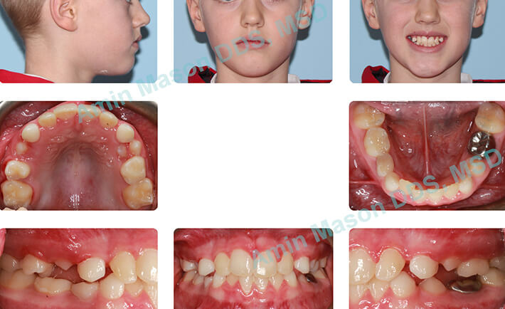 Young girl following correction of underbite