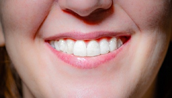 adult woman wearing Invisalign tray 