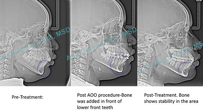 X-rays of bone grafting procedure