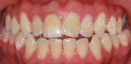 braces case 10 before