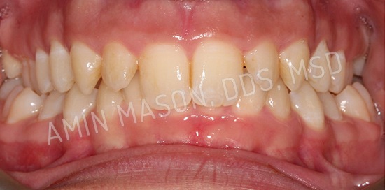braces case 4 before
