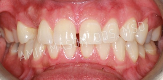 braces case 5 before