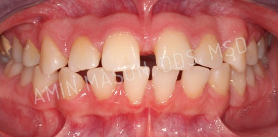 braces case 8 before