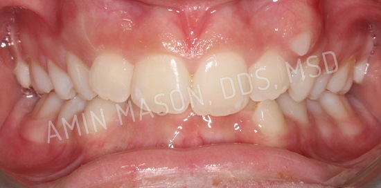 braces case 9 before