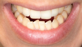 Close-up of man’s mouth with crowded teeth