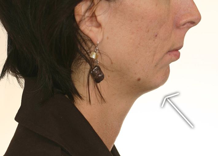 Chin deficient woman with lower face caved in