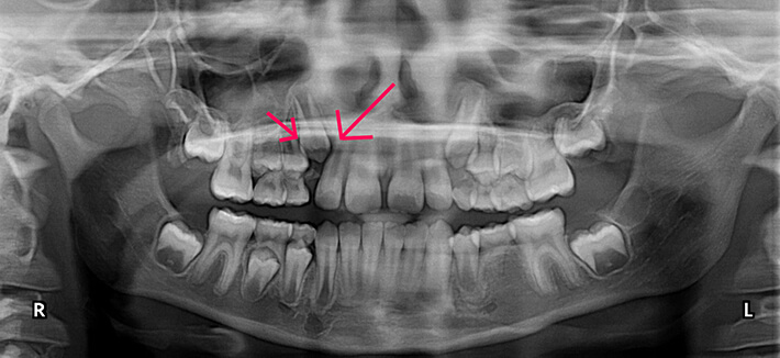 Panoramic dental x-ray showing crowding of teeth due to early tooth loss