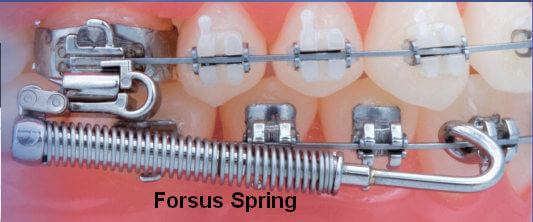 Image of teeth with Forsus appliance