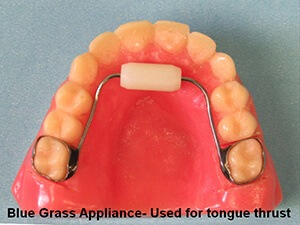 Model of teeth with habit appliances