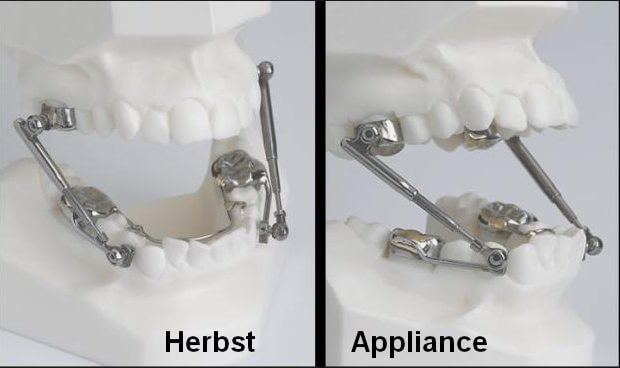 Overbite Correction Appliance Before After Gallery Post And Overbite Correction Appliance Before After Gallery Post And